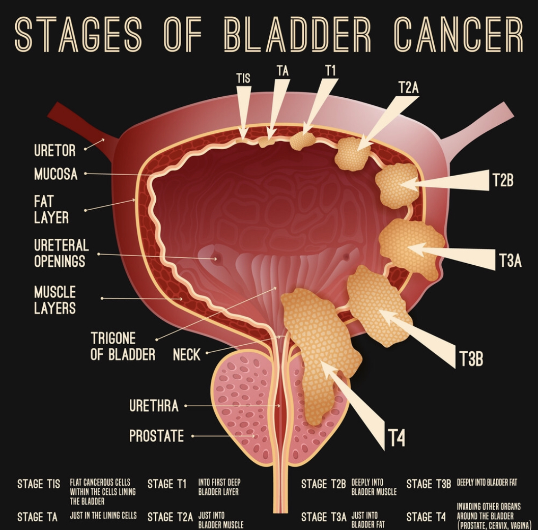 BLADDER CANCER Africa Cancer Hub